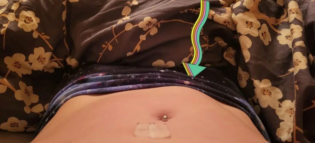 A Cyst Can Feel Like A Hernia