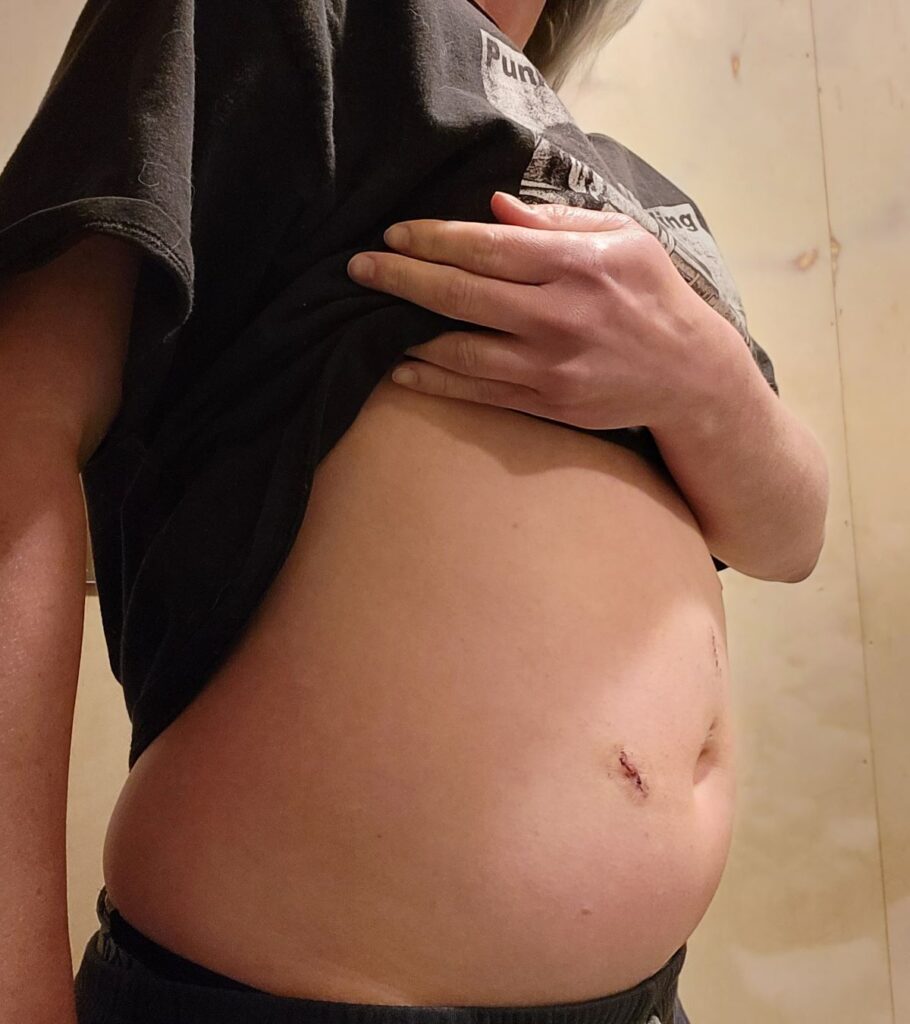 Exercise Relieves Post-Surgical Gas Pain